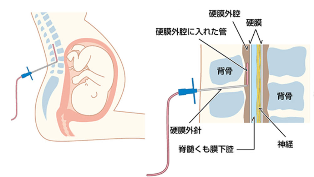 硬膜外麻酔
