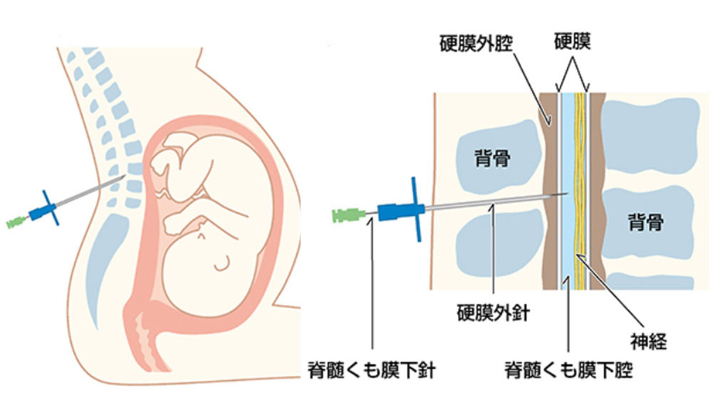 脊髄くも膜下麻酔