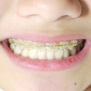 ワイヤーブラケット