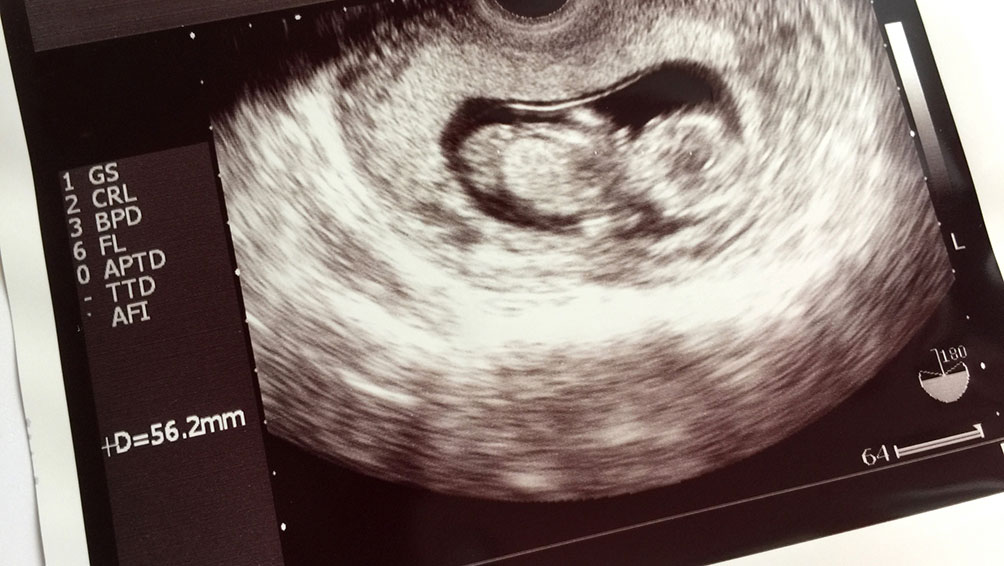 つわりを軽減するにはどうすればいい？時期・原因別対策法